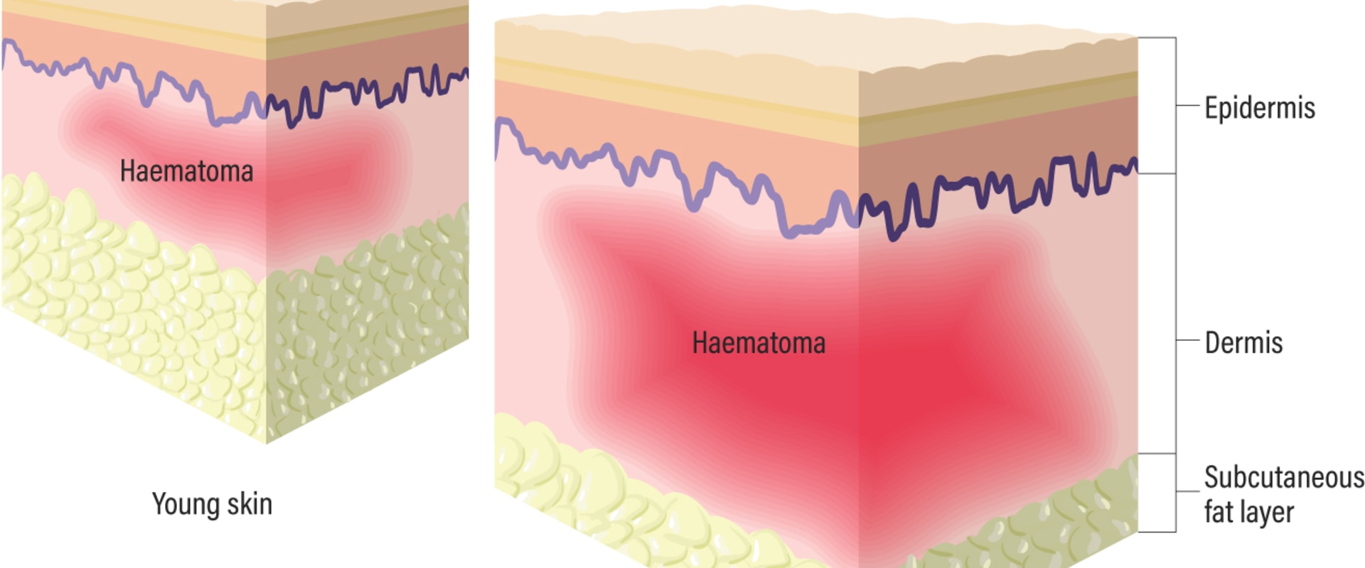 Exploring Skin Anatomy and Physiology to Address Wound Exudate Effectively