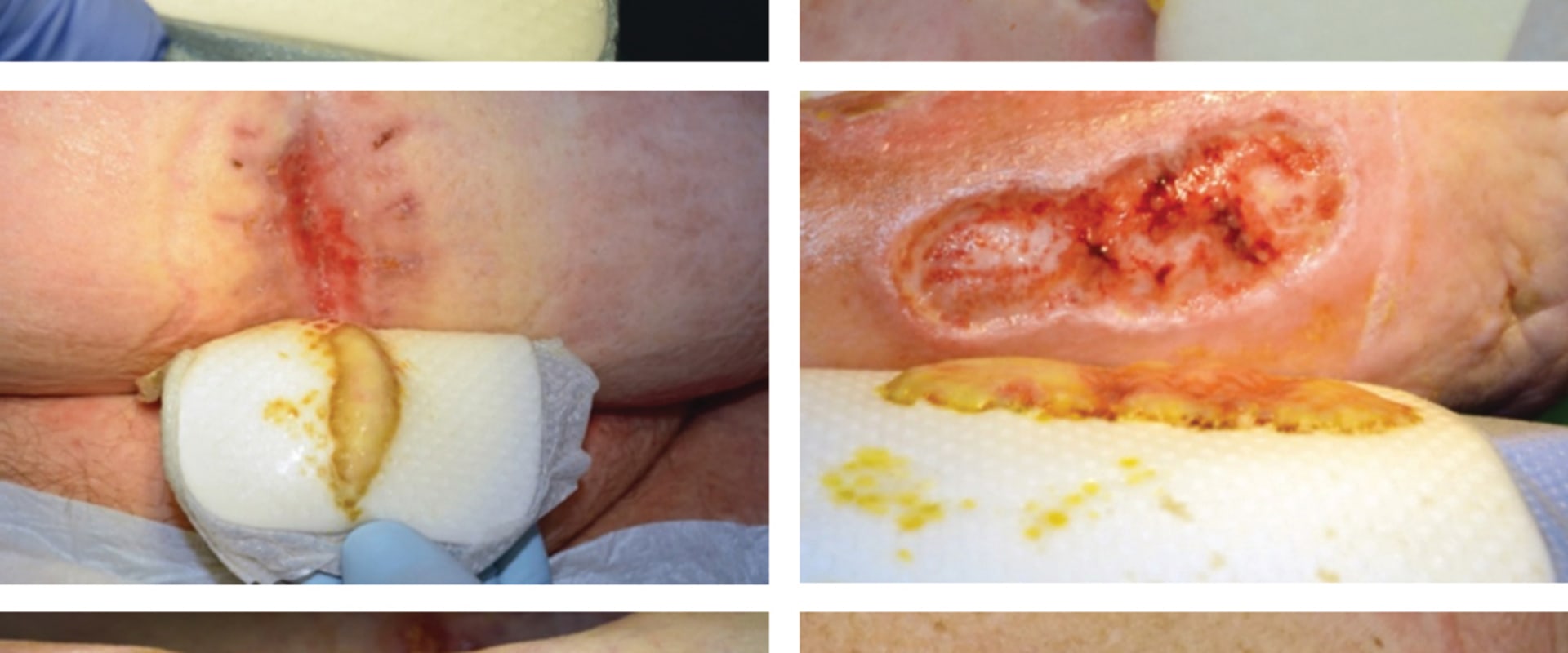 Understanding the Colors of Wound Exudate