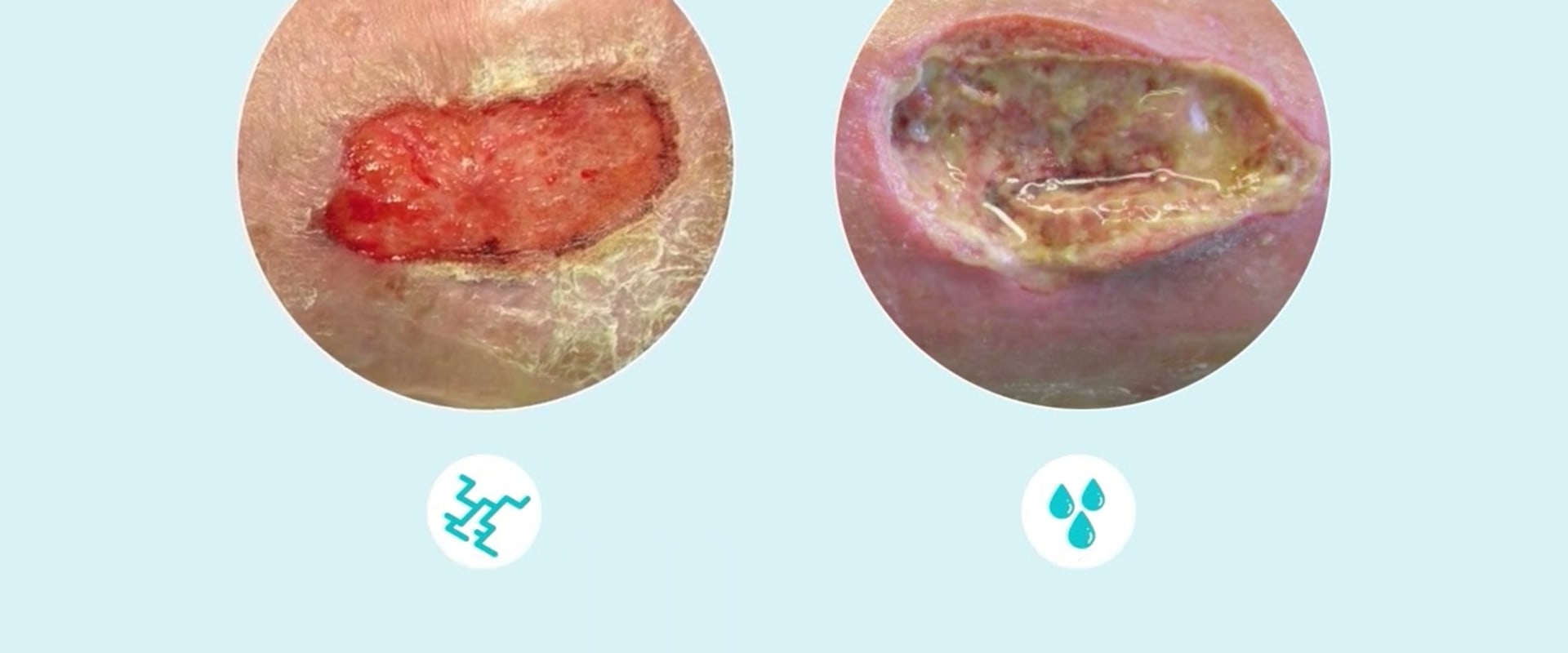 Understanding the Color of Exudate in Wound Healing