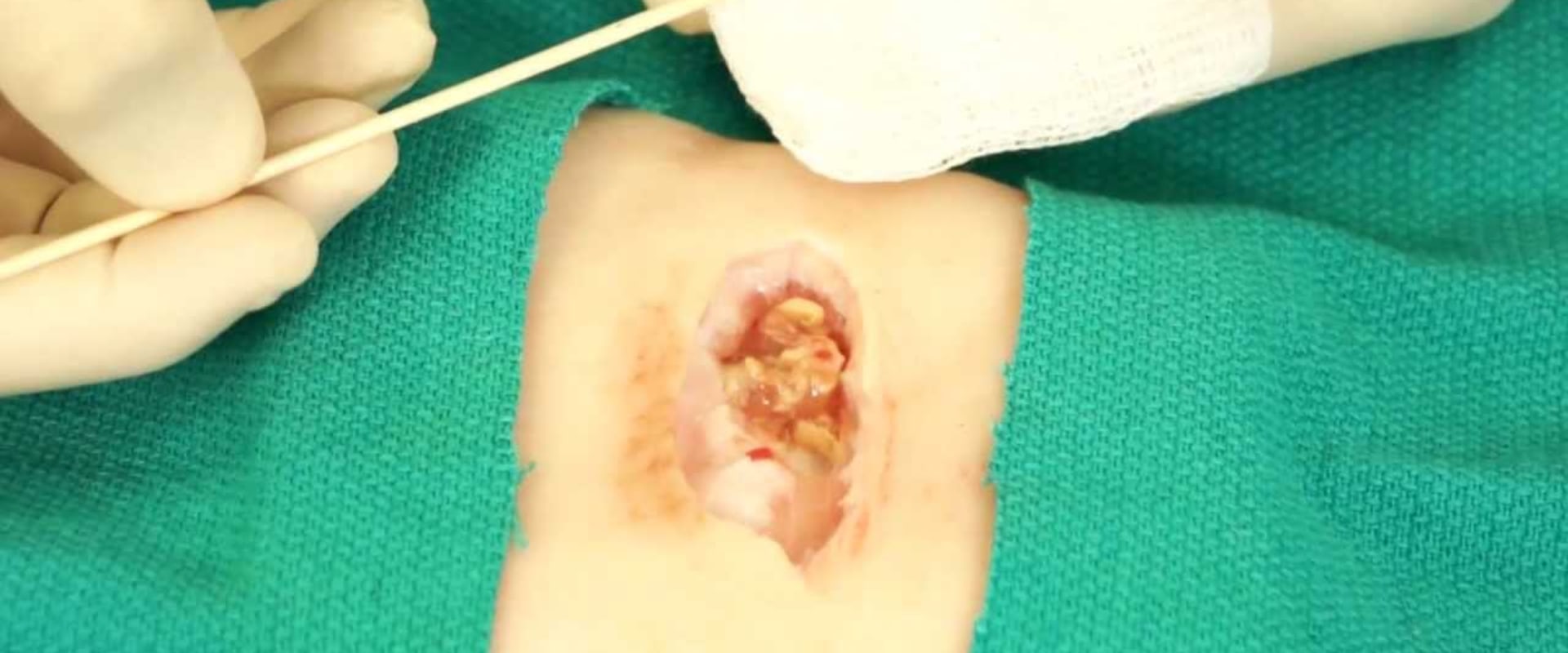 What Granulation Tissue Wound Pictures Tell You About Exudate and Healing Progress