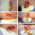 The Importance of Wound Exudate in the Healing Process