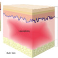 Exploring Skin Anatomy and Physiology to Address Wound Exudate Effectively