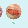 Understanding the Color of Exudate in Wound Healing