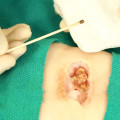 What Granulation Tissue Wound Pictures Tell You About Exudate and Healing Progress