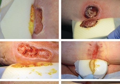 The Importance of Wound Exudate in the Healing Process