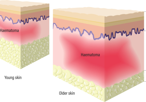 Exploring Skin Anatomy and Physiology to Address Wound Exudate Effectively