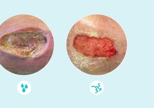 Understanding the Color of Exudate in Wound Healing