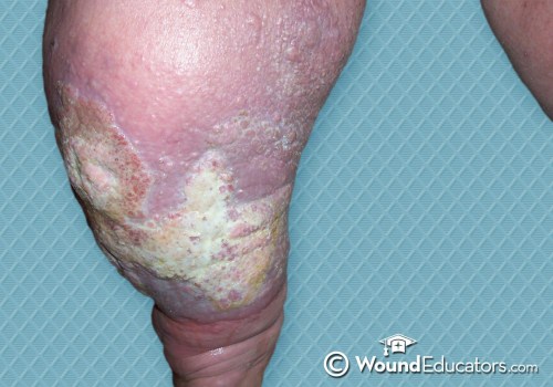 Understanding the Different Types of Wound Exudate