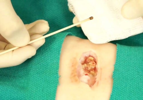 What Granulation Tissue Wound Pictures Tell You About Exudate and Healing Progress